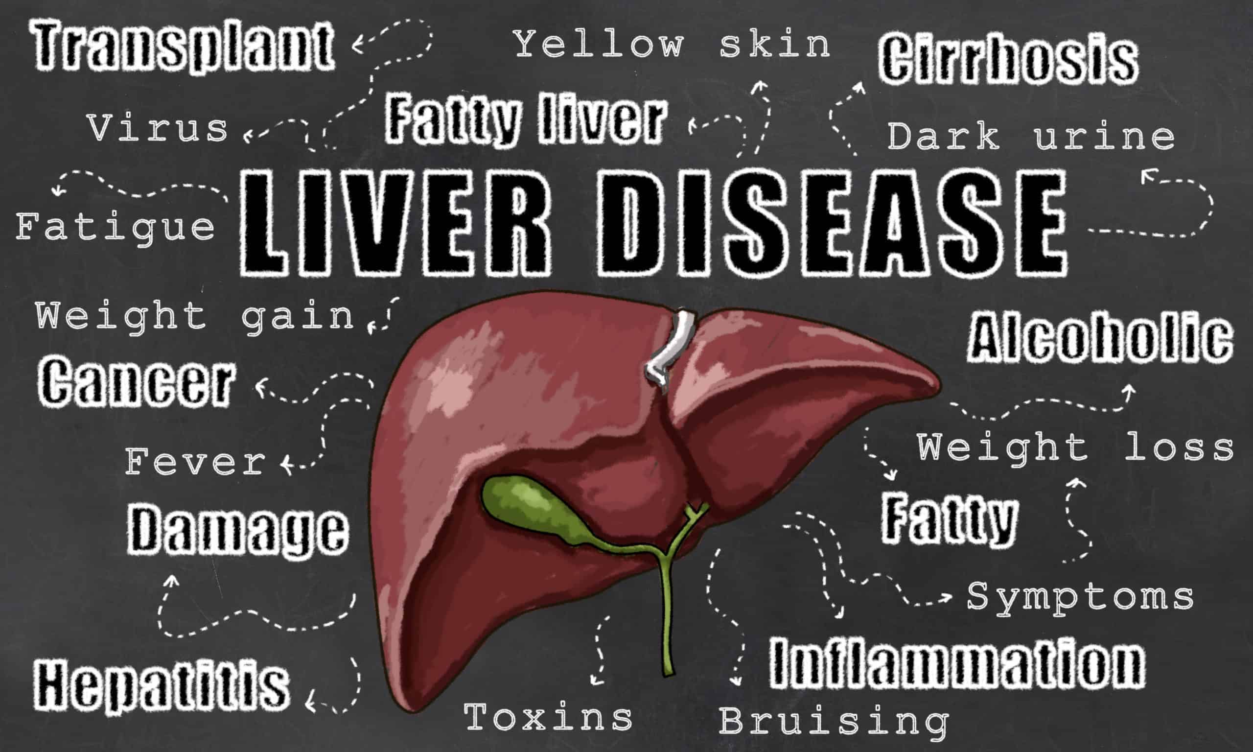 Liver Disease Illustration with Words of Liver Conditions on Blackboard